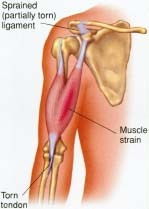 Sprain/Strain Image